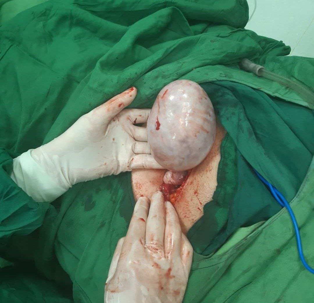 کیست بزرگ درموئید یا کیست مویی تخمدانی